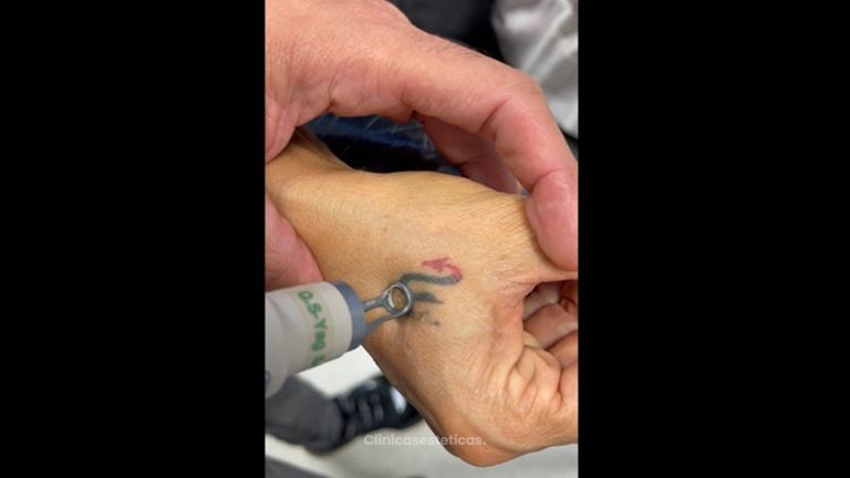 Borrar tatuajes - Dr. Jose Alejandro Marcano Delgado