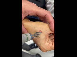 Borrar tatuajes - Dr. Jose Alejandro Marcano Delgado