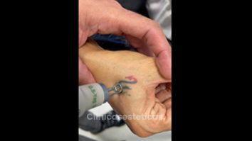 Borrar tatuajes - Dr. Jose Alejandro Marcano Delgado