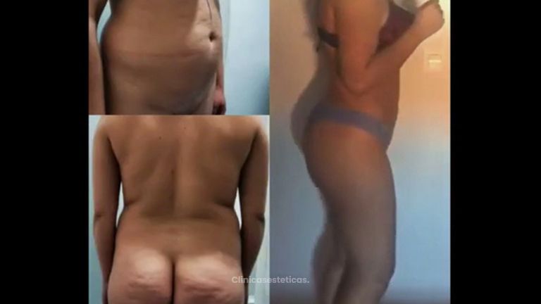 Liposucción