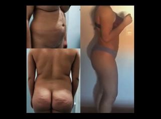 Liposucción 