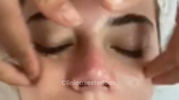 Limpieza facial profunda - Novastética