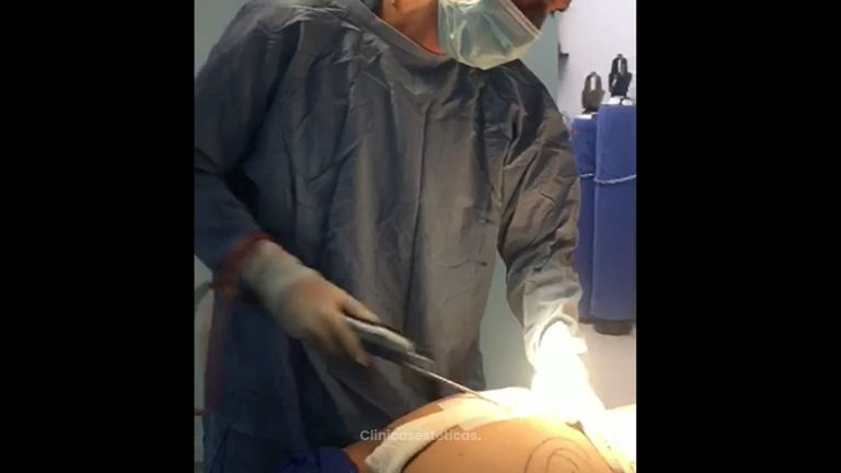 Lipoescultura asistida con microaire