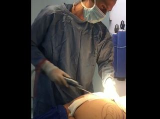 Lipoescultura asistida con microaire