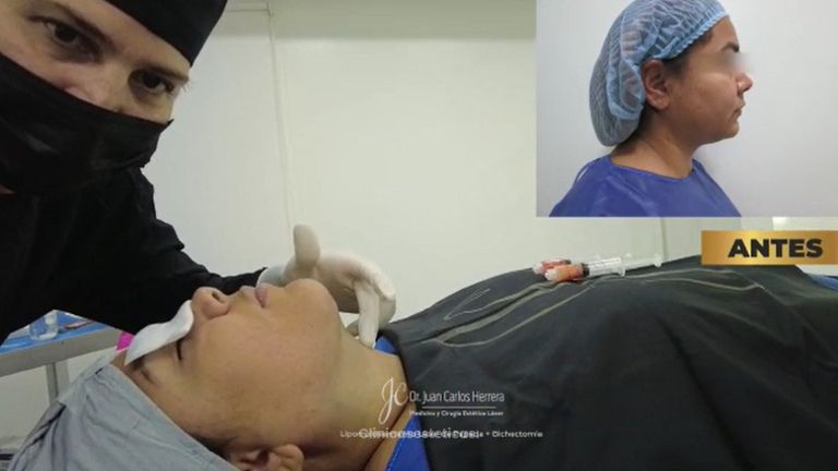 Cirugía de papada - Dr. Juan Carlos Herrera P.