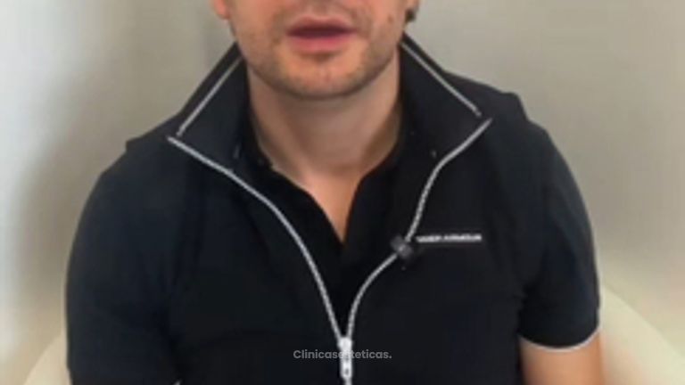 Real Hair Transplant Experience - Pilocare