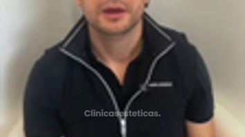 Real Hair Transplant Experience - Pilocare