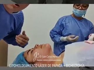 Lipo Papada