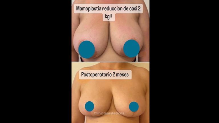 Mamoplastia de Reducción - Dra. Andrea Halliday Rueda