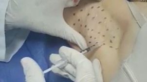 Que es hiperhidrosis 