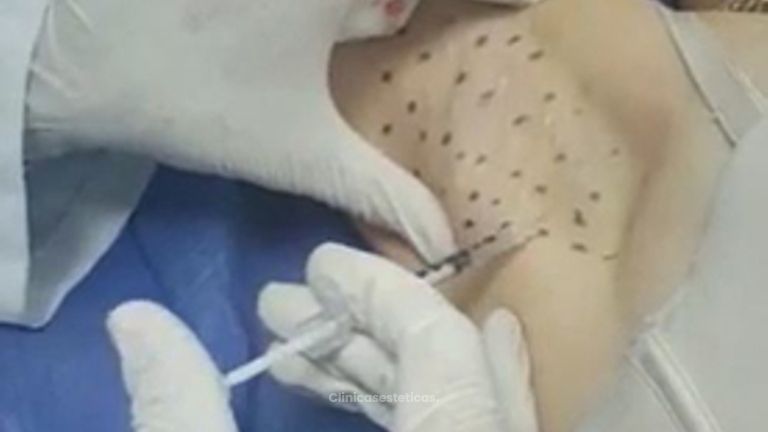 Hiperhidrosis Axilar. Eliminación de exceso de sudor en axilas.