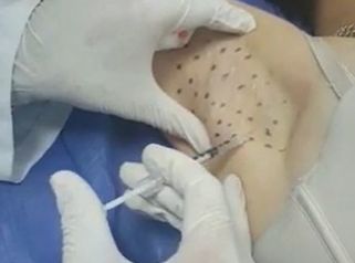Hiperhidrosis Axilar. Eliminación de exceso de sudor en axilas.
