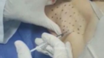 Hiperhidrosis Axilar. Eliminación de exceso de sudor en axilas.