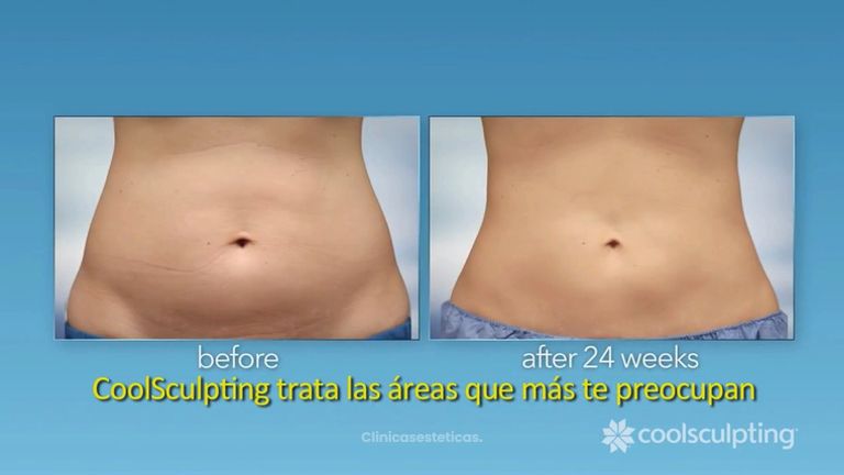 Coolsculpting - El procedimiento lìder en esculpir el cuerpo perfecto