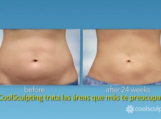 Coolsculpting - El procedimiento lìder en esculpir el cuerpo perfecto