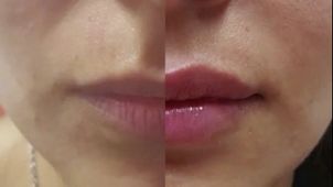 Técnicas para aumentar los labios
