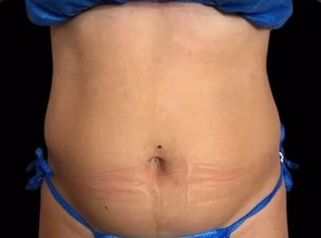 Liposucción - Dra. Ángeles Esmeral