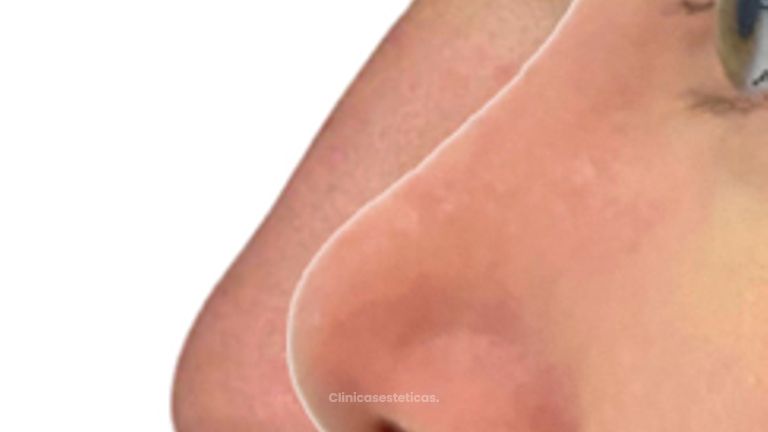 Rinoplastia - Doctora Alexandra Mora