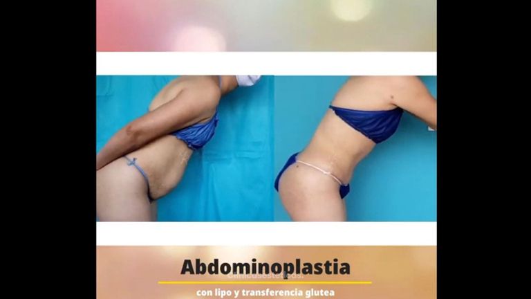 Abdominoplastia - Dr. Milton Rincón Carranza