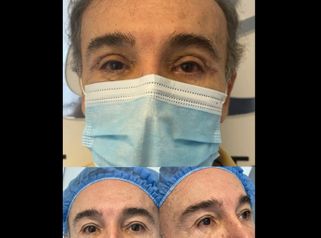 Blefaroplastia - Dr. Jarold Effer Taylor