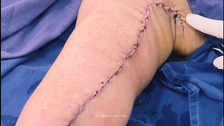 Braquioplastia antes y despues 