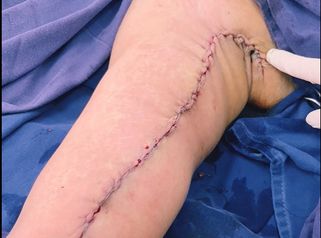 Braquioplastia antes y despues 