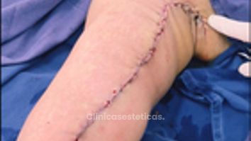 Braquioplastia antes y despues 