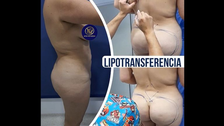 Liposucción - Dr. Victor Hugo Quevedo