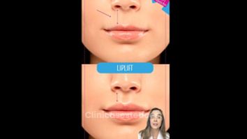 Liplift - Doctora Alexandra Mora