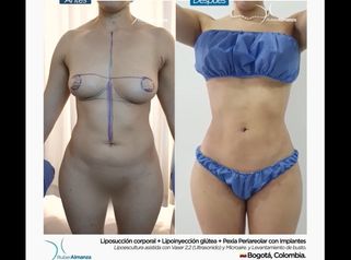 Liposucción corporal + Lipoinyeccion glútea + Pexia con implantes