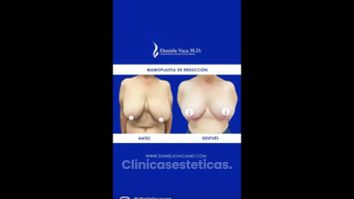 Mamoplastia de reducción - Dra. Daniela Stephania Vaca Grisales