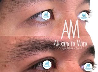 Blefaroplastia Superior - Doctora Alexandra Mora