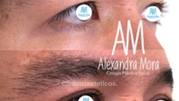 Blefaroplastia Superior - Doctora Alexandra Mora