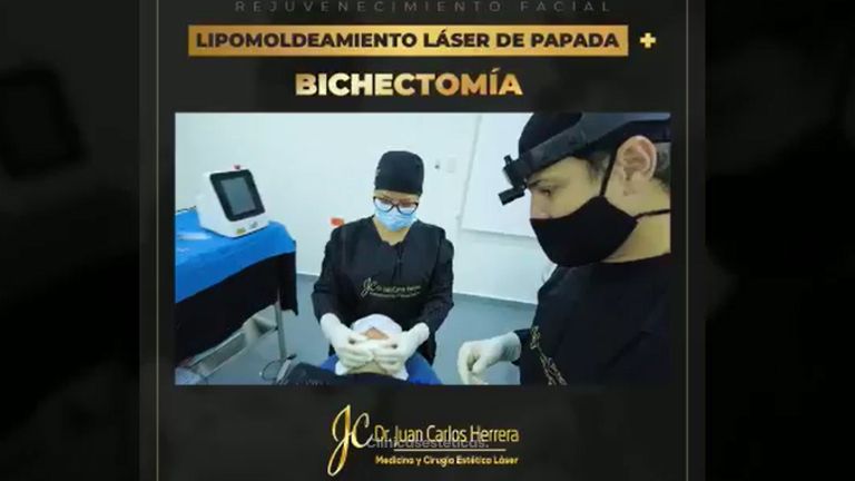 Bichectomía - Dr. Juan Carlos Herrera P.