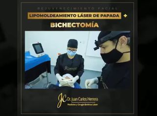 Bichectomía - Dr. Juan Carlos Herrera P.