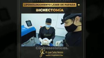 Bichectomía - Dr. Juan Carlos Herrera P.