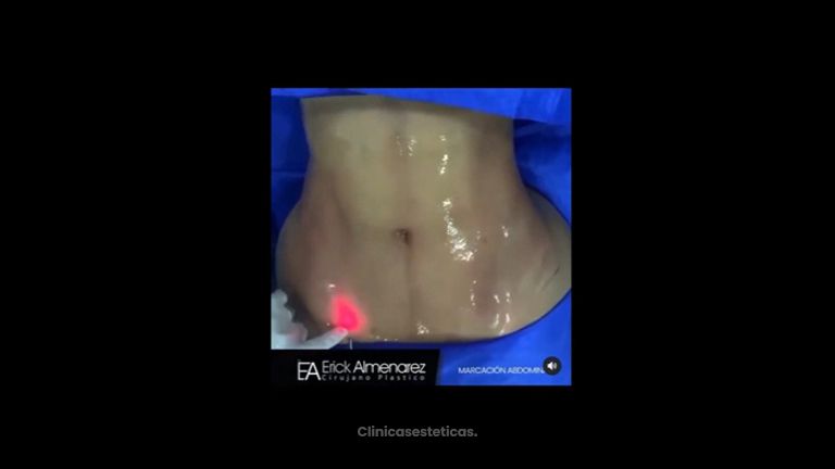 Liposucción - Dr. Erick Almenárez Mendoza