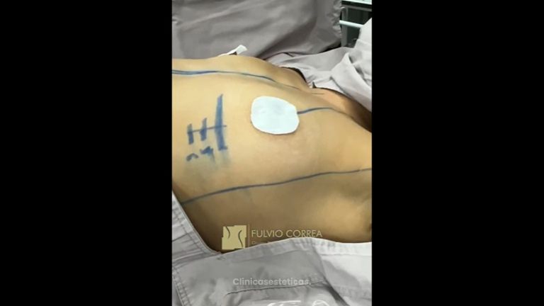 Mamoplastia de aumento - Dr Fulvio Alexander Correa