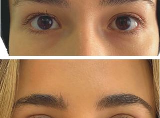 Blefaroplastia - Doctora Alexandra Mora