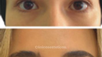 Blefaroplastia - Doctora Alexandra Mora