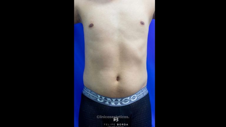 Liposucción - Dr. Luis Felipe Borda
