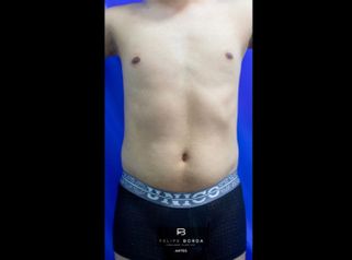 Liposucción - Dr. Luis Felipe Borda