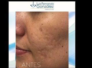 Tratamiento Facial