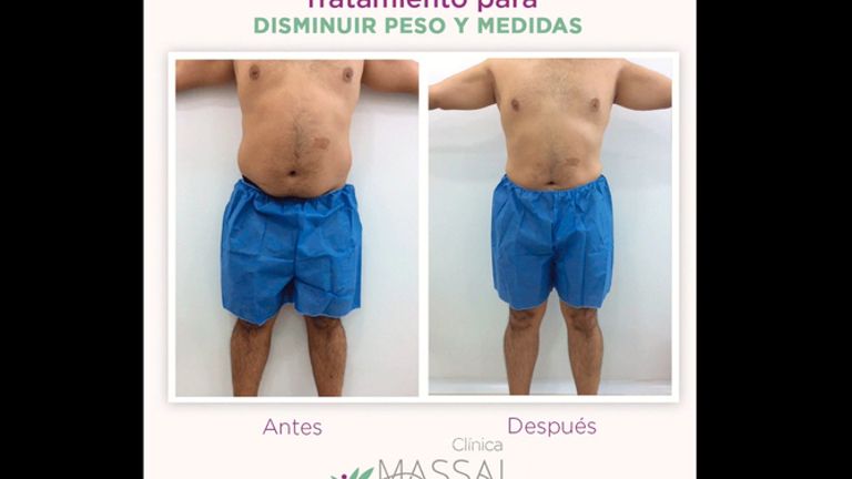 Tratamientos para adelgazar - Massai Clínica