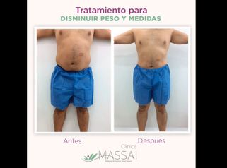Tratamientos para adelgazar - Massai Clínica