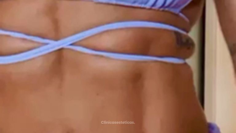 Liposucción - Dr. Zamir Páez