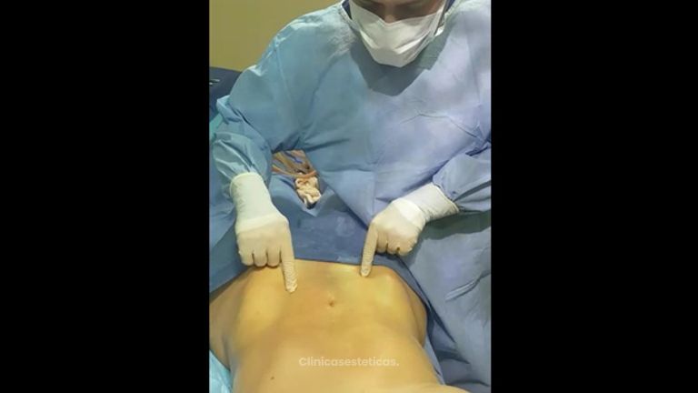 Marcación Abdominal 