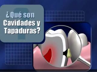 Caries dentales 