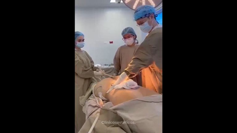 Liposucción - Dr. Alejandro Ruiz Cortés