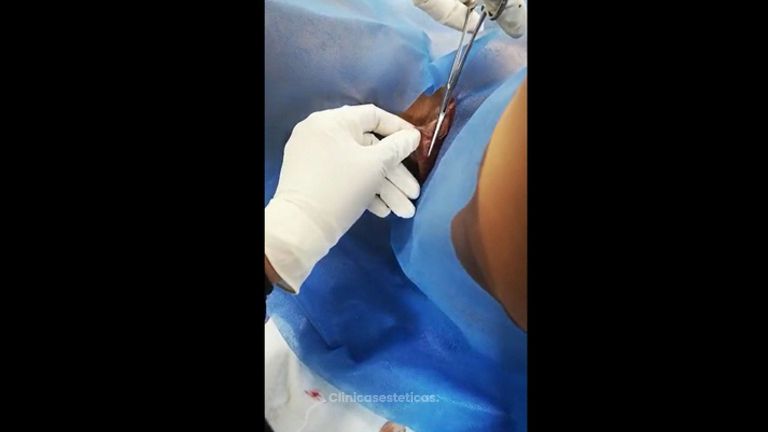 Labioplastia - Dra. Yulieth Figueroa Peñaranda